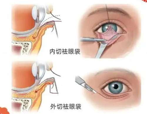 去眼袋 去眼袋