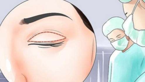 双眼皮 双眼皮