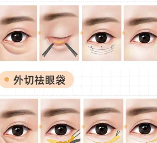 去眼袋 去眼袋