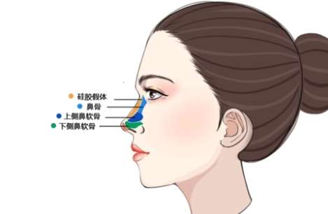 隆鼻 隆鼻