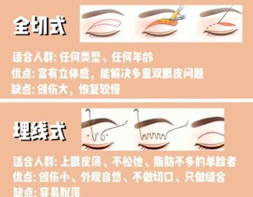 双眼皮 双眼皮