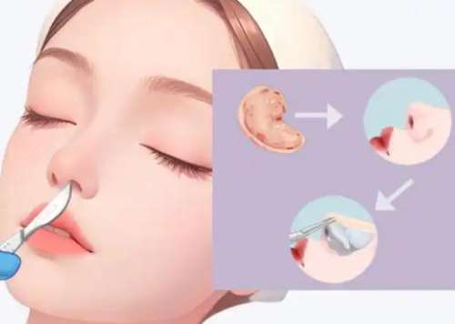 隆鼻隆鼻 隆鼻隆鼻