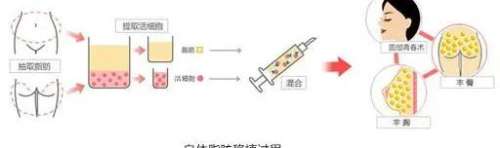 自体脂肪移植.jpg 自体脂肪移植.jpg