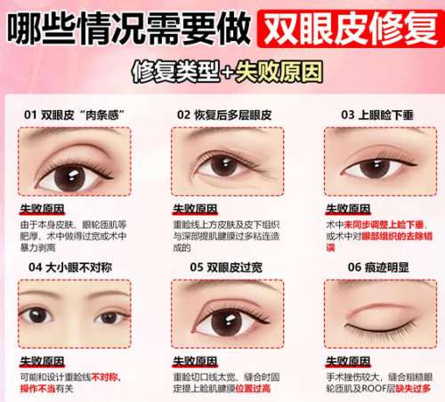 双眼皮 双眼皮