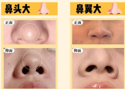 隆鼻 隆鼻