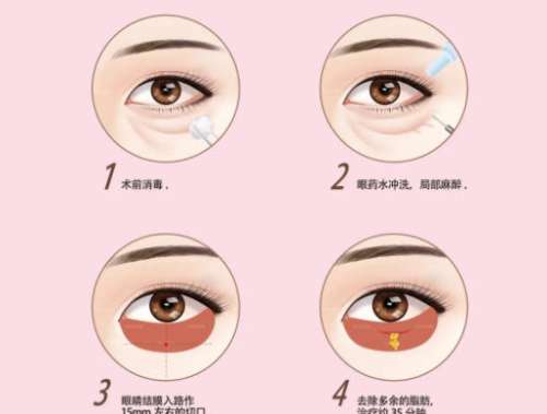 去眼袋 去眼袋