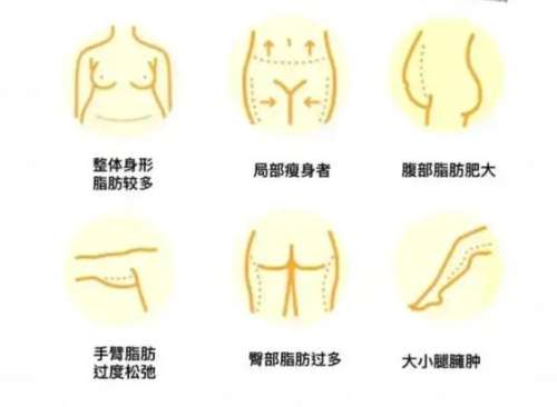 吸脂 吸脂
