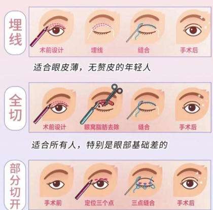 双眼皮 双眼皮