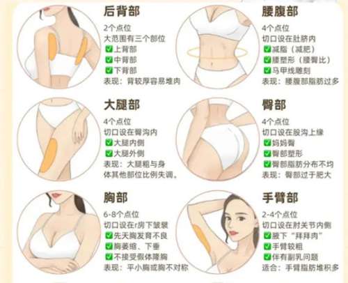 吸脂 吸脂