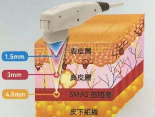 除皱 除皱