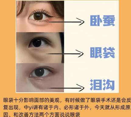 去眼袋 去眼袋