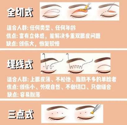 双眼皮 双眼皮