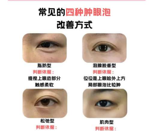双眼皮 双眼皮