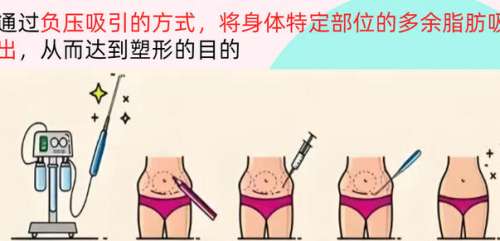 腰腹吸脂dm3.jpg