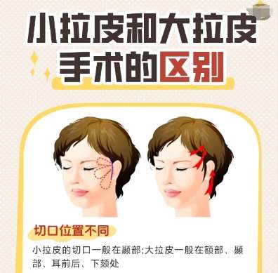 侯典举拉皮手术案例图展示！拉皮手法口碑在线！避坑必看