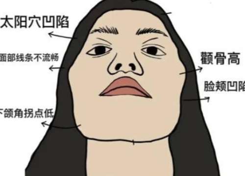 颧骨内推 颧骨内推