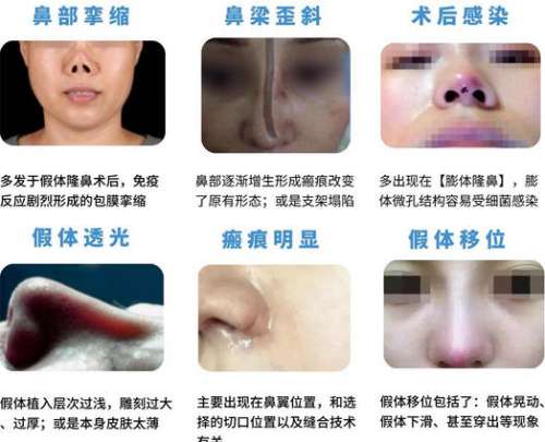 鼻修复dm1.jpg