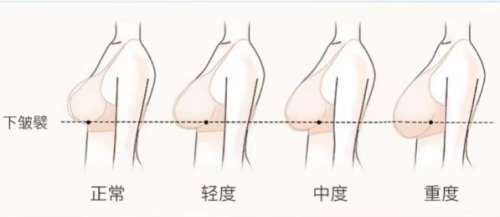 乳房悬吊 乳房悬吊