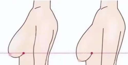 乳房下垂矫正 乳房下垂矫正