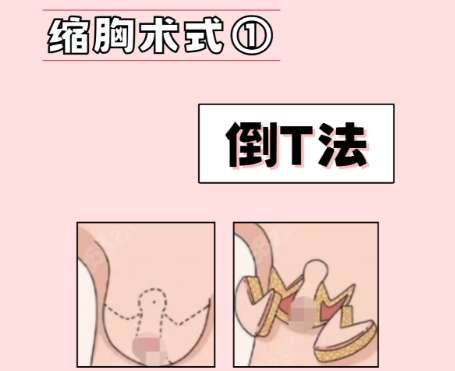 缩胸 缩胸