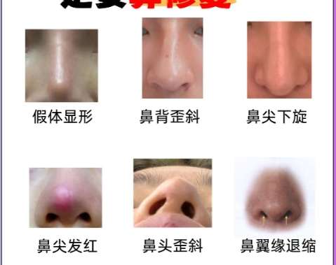 歪鼻矫正 歪鼻矫正