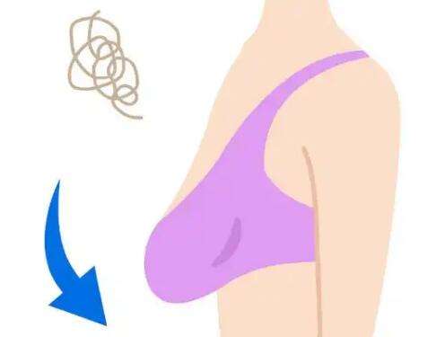 乳房下垂矫正3.jpg