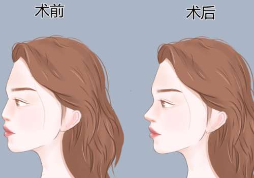 隆鼻.jpg