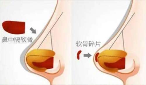 鼻中隔软骨隆鼻1.jpg