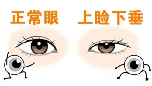 上睑下垂矫正02.jpg