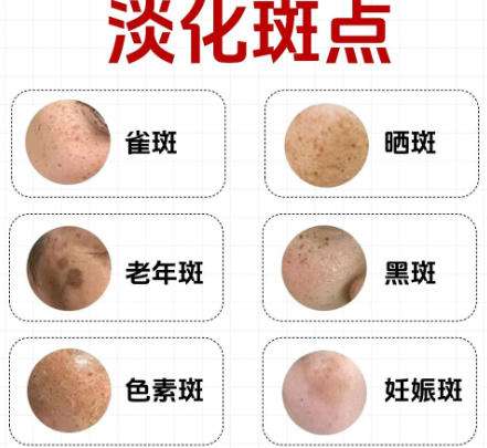 闫爱萍手术费用多少？2026收费细节展示！激光祛斑4千8起
