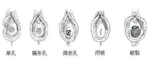 处女膜 处女膜