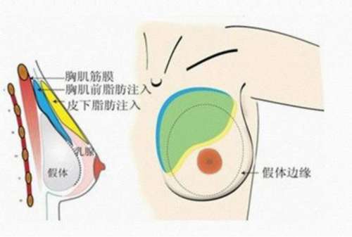 隆胸手术原理图01.jpg 隆胸手术原理图01.jpg