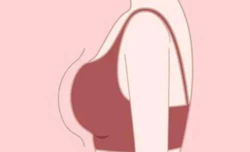 隆胸 隆胸