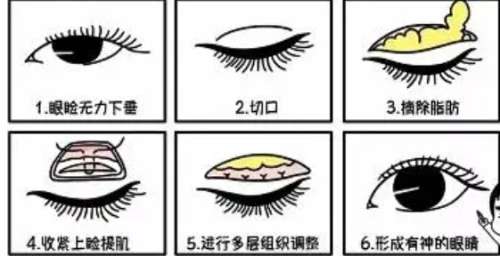 双眼皮修复 双眼皮修复