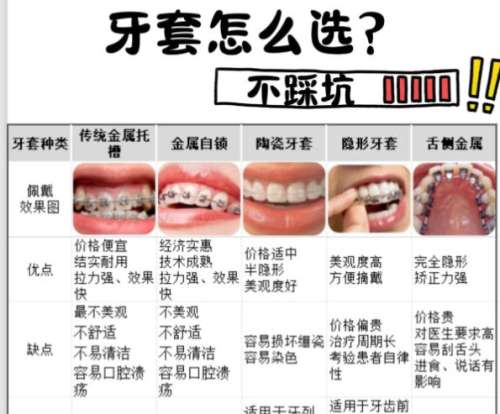 牙齿矫正 牙齿矫正
