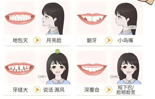 牙齿矫正 牙齿矫正