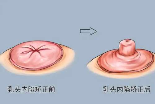 乳头内陷动漫02.jpg 乳头内陷动漫02.jpg
