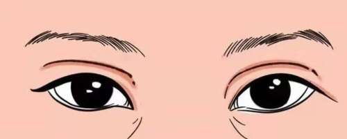 双眼皮修复 双眼皮修复