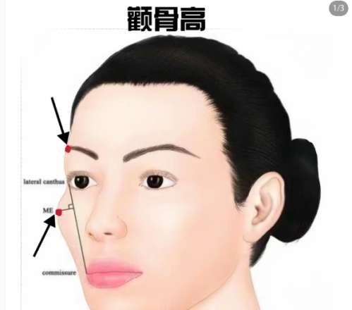 颧骨 颧骨