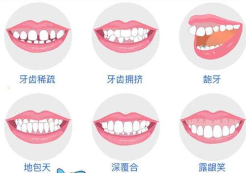 牙齿矫正 牙齿矫正