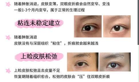 双眼皮  .jpg