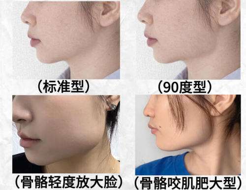 下颌角3.jpg 下颌角3.jpg