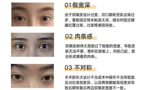 双眼皮修复2.jpg 双眼皮修复2.jpg