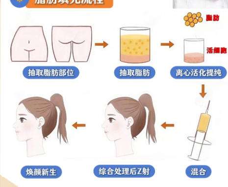 脂肪填充1.jpg