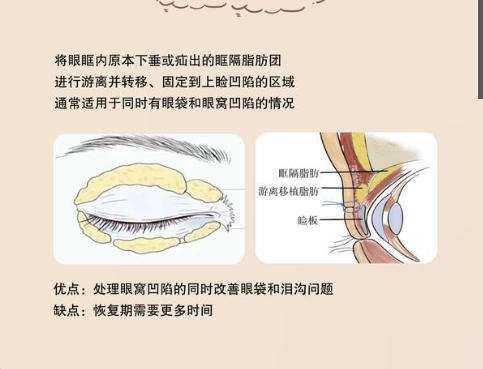 脂肪填充2.jpg