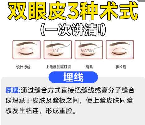 双眼皮4.jpg