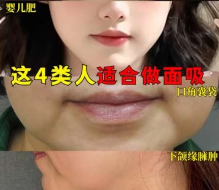 面部吸脂 面部吸脂