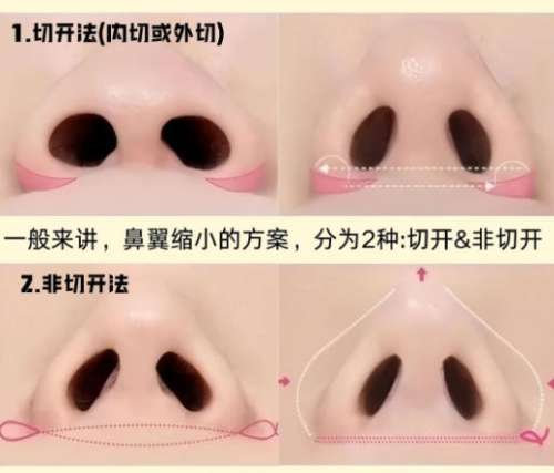 隆鼻12.jpg