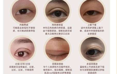 双眼皮修复3.jpg 双眼皮修复3.jpg