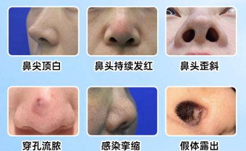 隆鼻5.jpg